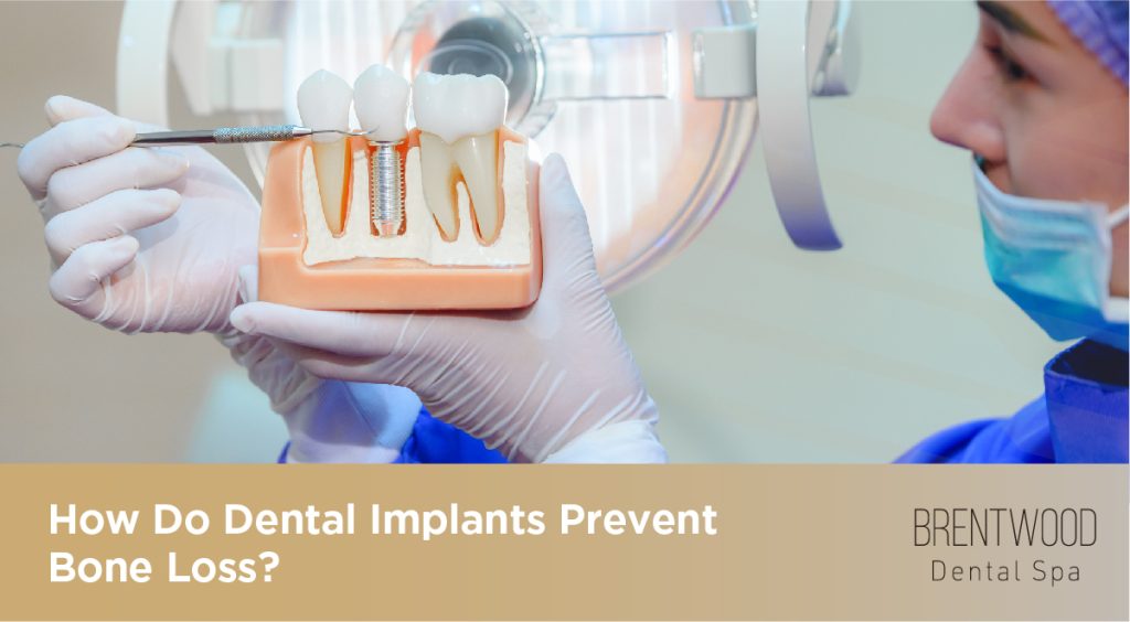 How Do Dental Implants Prevent Bone Loss - Dental Implants Brentwood California - Dental Implants Near Me - Best Dental Implants Brentwood CA - Dental Implant Dentist